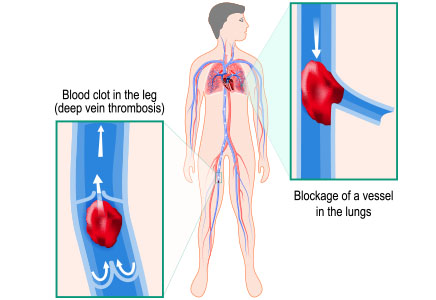 small blood clot in leg