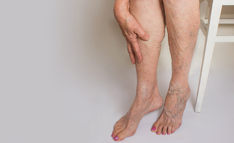 Recognizing the Signs and Symptoms of Deep Vein Thrombosis